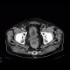 Colorectal cancer, carcinoma of rectum: CT - Computed tomography